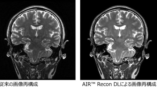 「GEヘルスケア・ジャパン」、新プラットホーム「AIR™ IQ Edition」を全MRI製品で販売開始