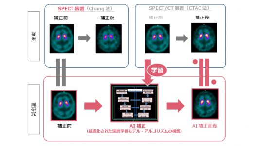 AIを用いた新たな脳核医学検査手法の開発に着手
