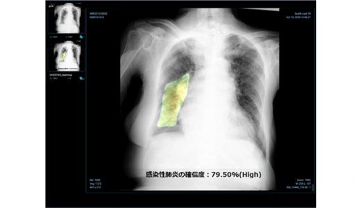 新型コロナウイルス肺炎を含む感染性肺炎の画像診断を支援する胸部X線AIエンジンの薬事承認を日本で初めて取得