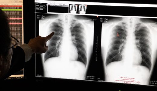 人工知能を活用した「AI支援胸部がん検診読影システム」の運用を開始
