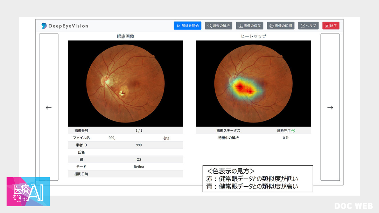 DeepEyeVision for RetinaStation 画面の一例。ヒートマップで逸脱を可視化する。