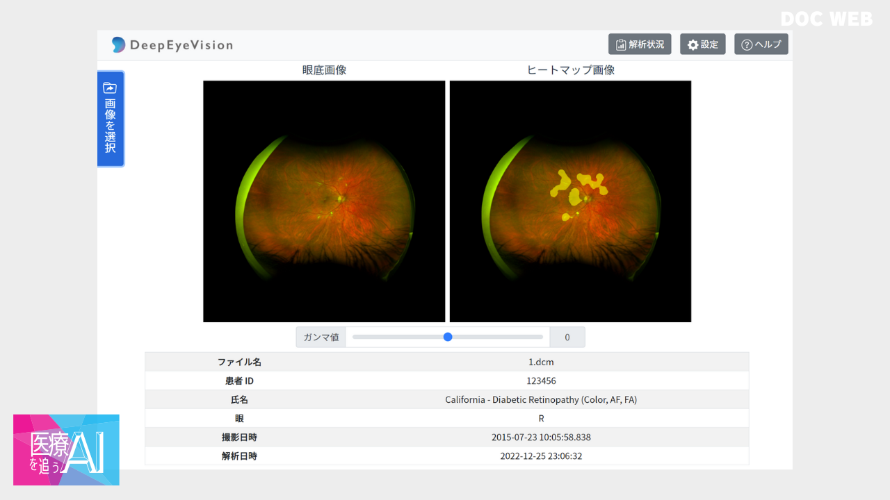 DeepEyeVision for California 画面の一例。血管の密度が正常から逸脱した箇所 （NPA）
を映し出す。